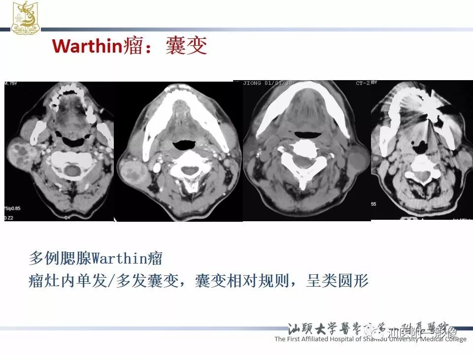 影像PPT - 【PPT】腮腺病变CT诊断-50
