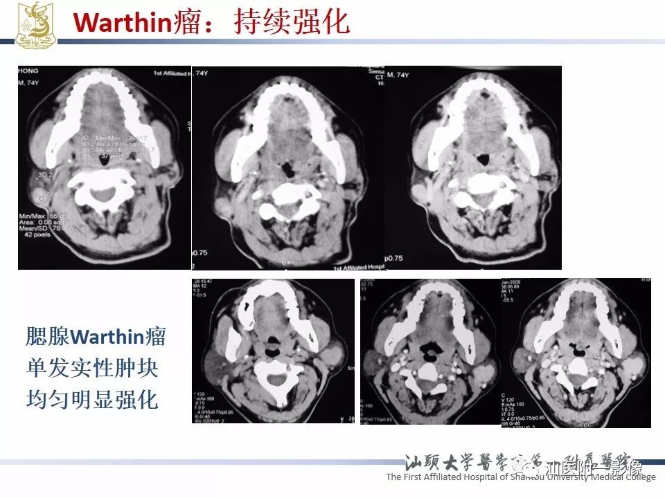 影像PPT - 【PPT】腮腺病变CT诊断-51