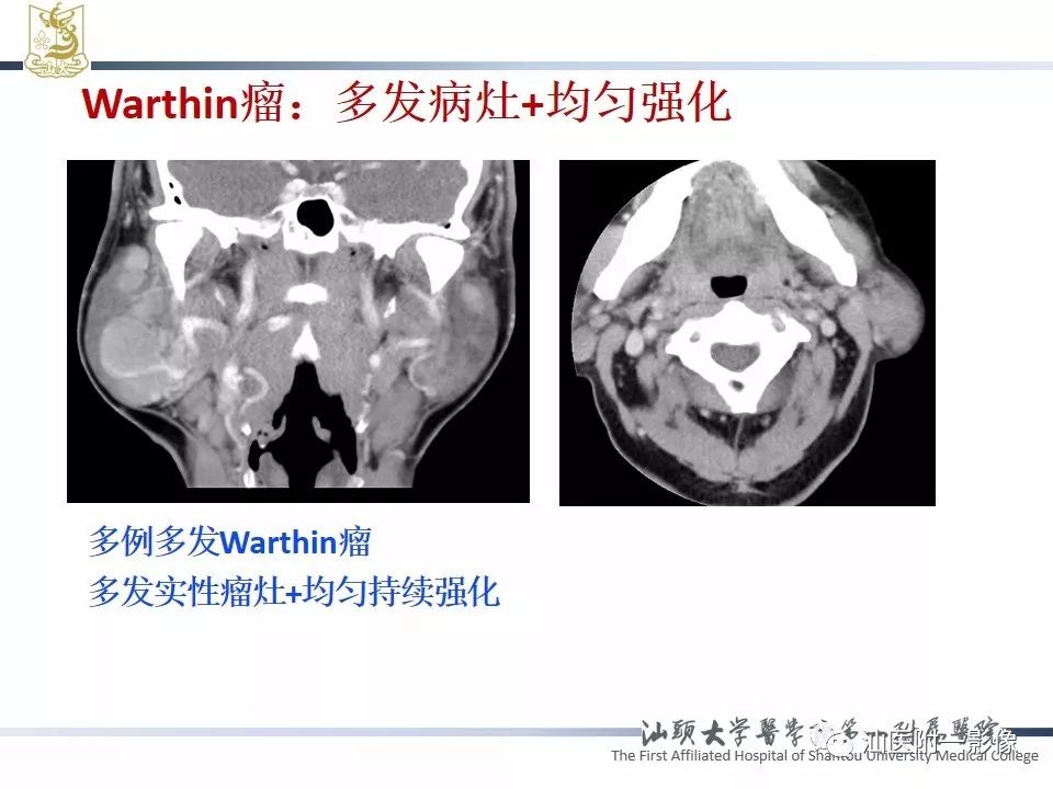 影像PPT - 【PPT】腮腺病变CT诊断-52