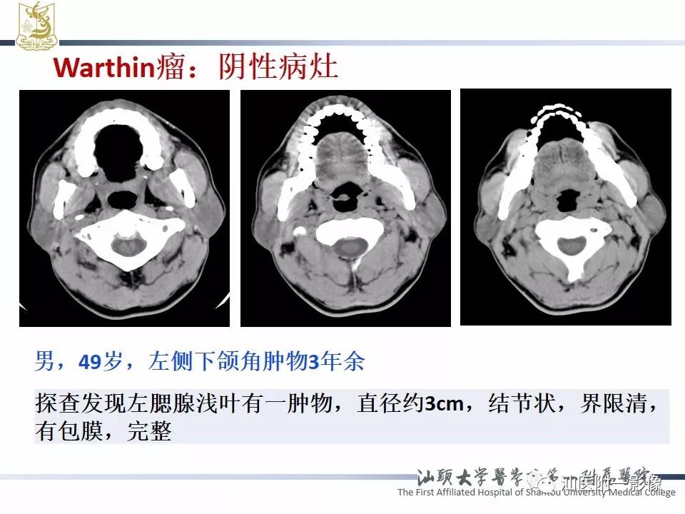 影像PPT - 【PPT】腮腺病变CT诊断-53