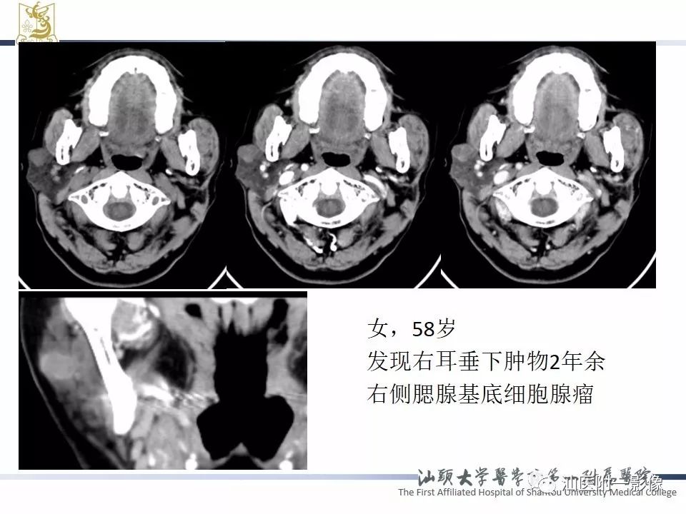 影像PPT - 【PPT】腮腺病变CT诊断-56