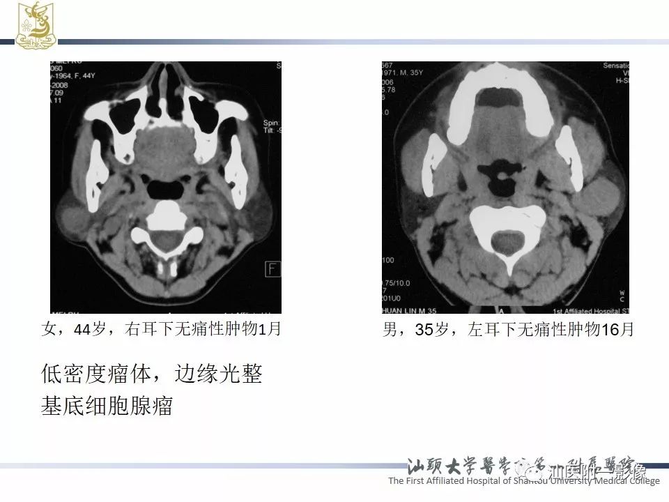 影像PPT - 【PPT】腮腺病变CT诊断-58