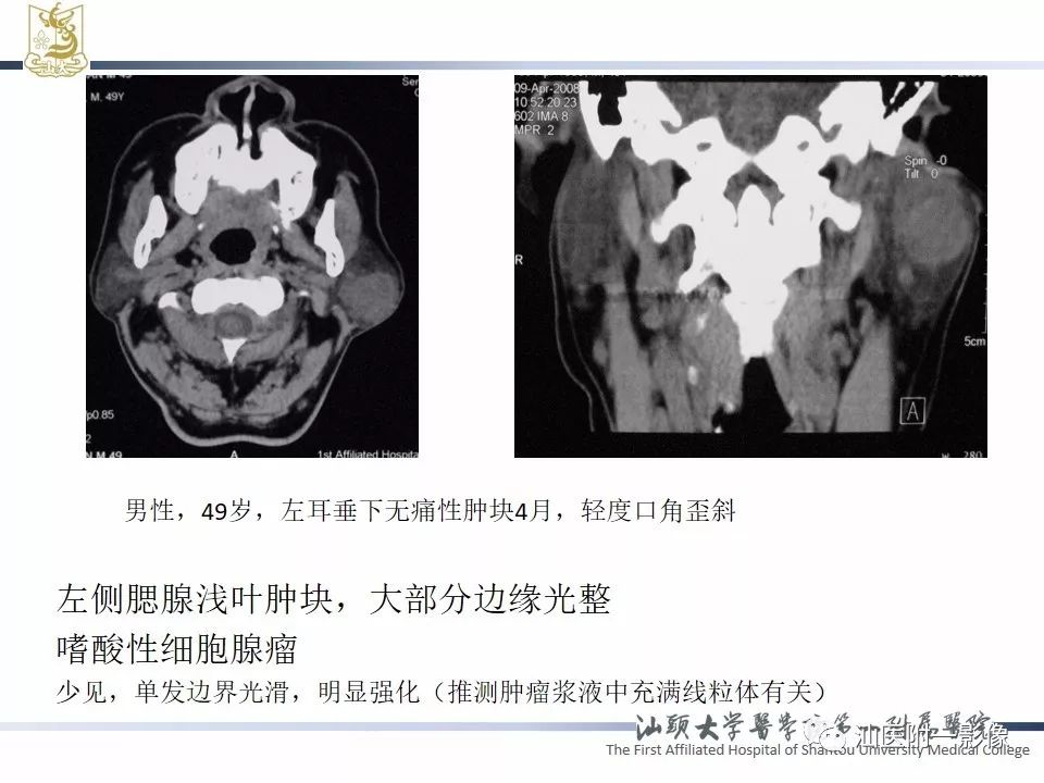 影像PPT - 【PPT】腮腺病变CT诊断-59