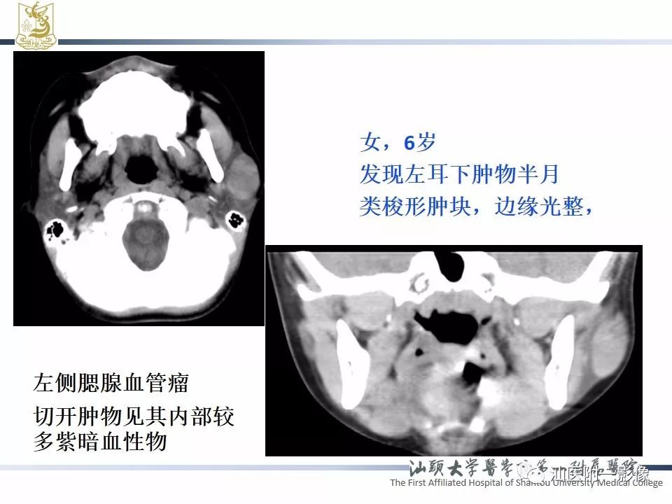 影像PPT - 【PPT】腮腺病变CT诊断-62