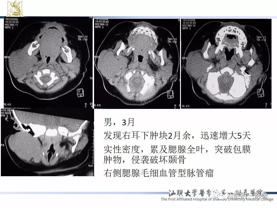 影像PPT - 【PPT】腮腺病变CT诊断-63