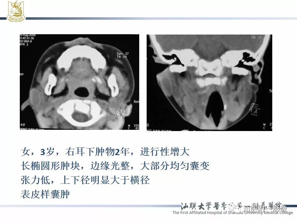 影像PPT - 【PPT】腮腺病变CT诊断-64