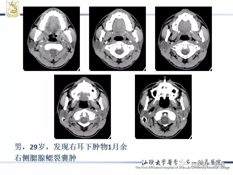 影像PPT - 【PPT】腮腺病变CT诊断-65