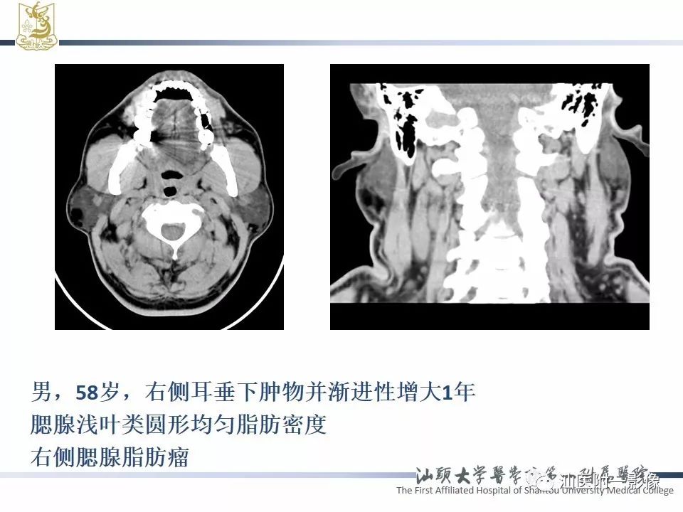 影像PPT - 【PPT】腮腺病变CT诊断-66
