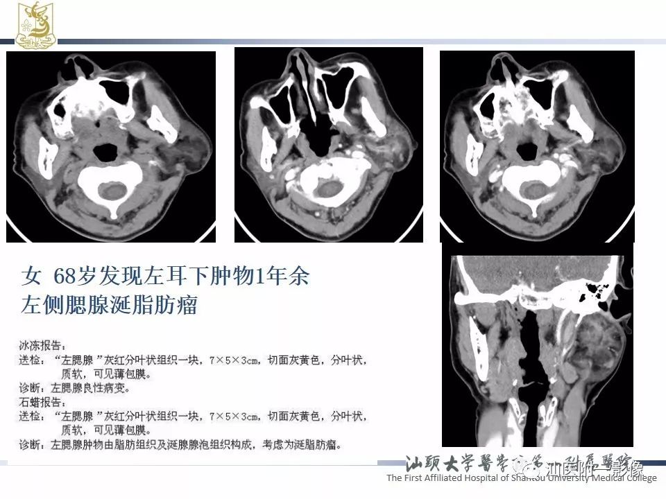 影像PPT - 【PPT】腮腺病变CT诊断-67