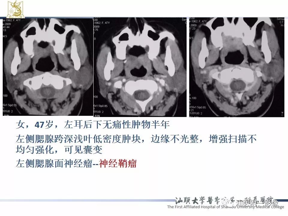 影像PPT - 【PPT】腮腺病变CT诊断-68