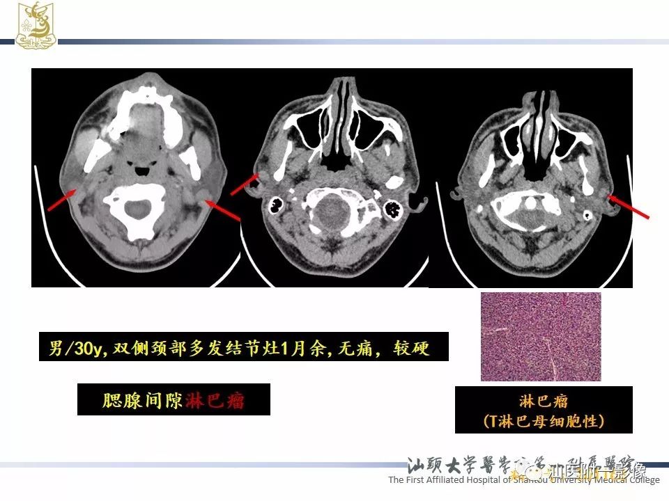影像PPT - 【PPT】腮腺病变CT诊断-69