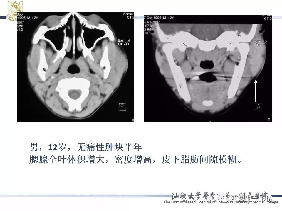 影像PPT - 【PPT】腮腺病变CT诊断-72