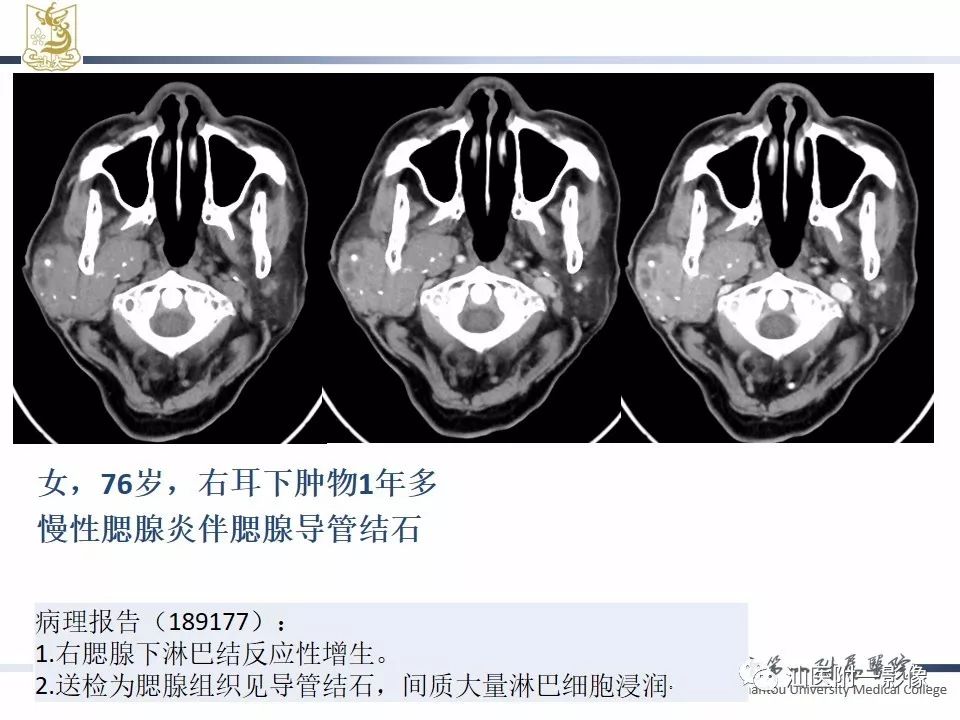 影像PPT - 【PPT】腮腺病变CT诊断-73