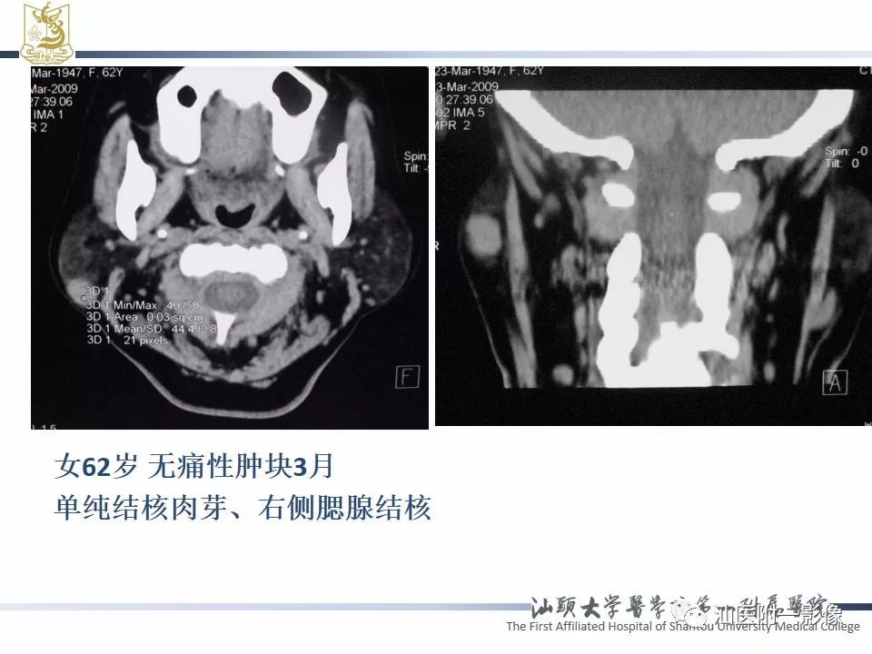 影像PPT - 【PPT】腮腺病变CT诊断-75