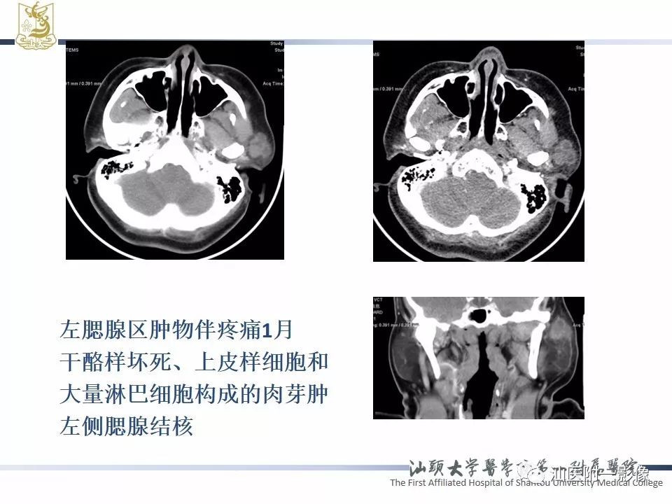 影像PPT - 【PPT】腮腺病变CT诊断-76