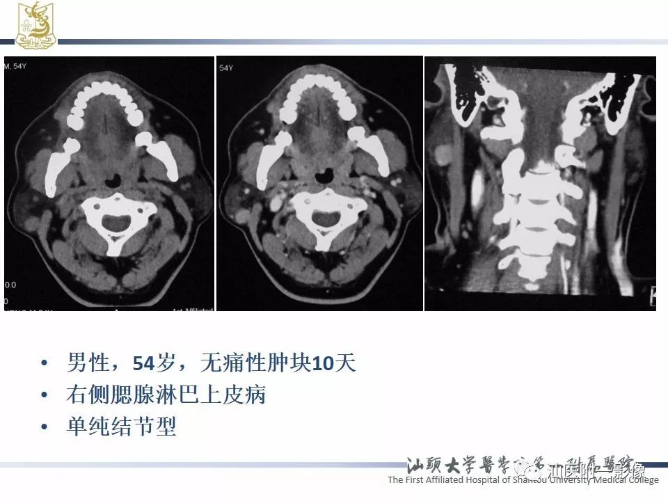 影像PPT - 【PPT】腮腺病变CT诊断-78