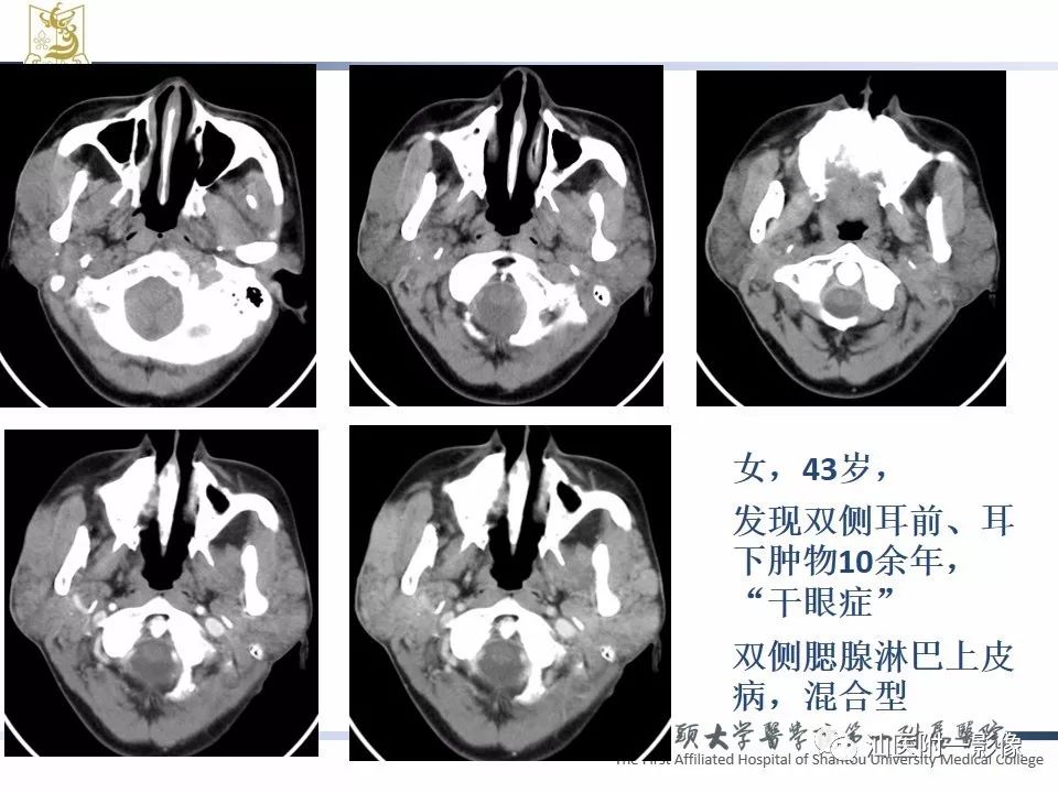 影像PPT - 【PPT】腮腺病变CT诊断-79