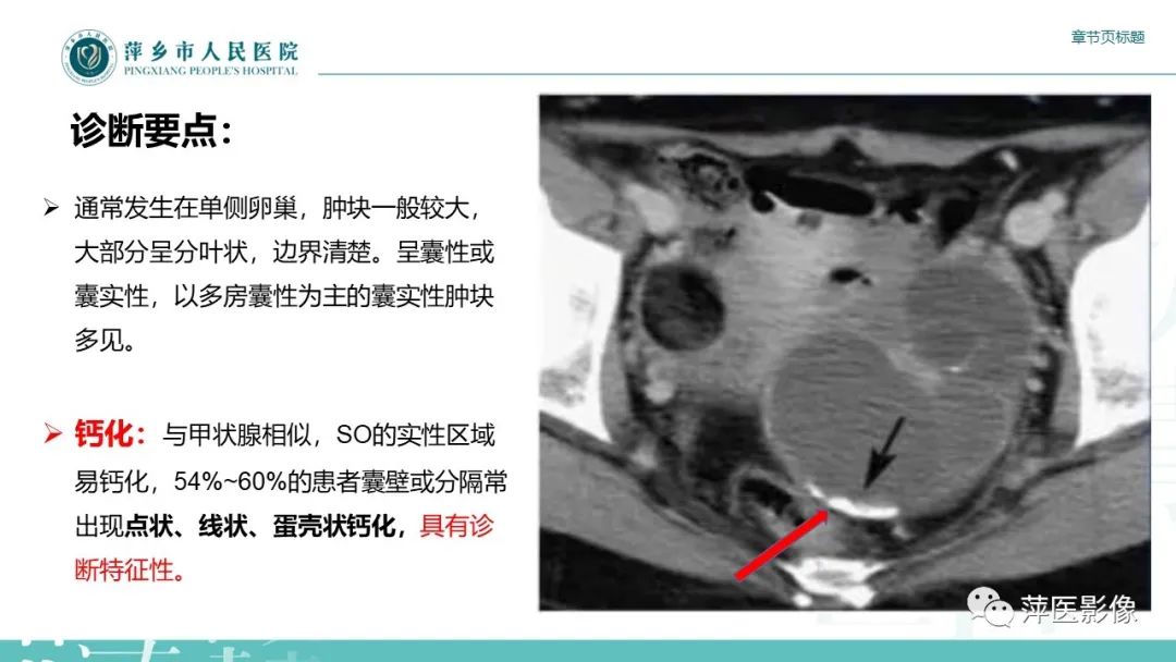 影像PPT - 【PPT】卵巢甲状腺肿-11