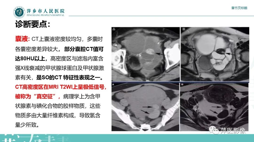 影像PPT - 【PPT】卵巢甲状腺肿-12