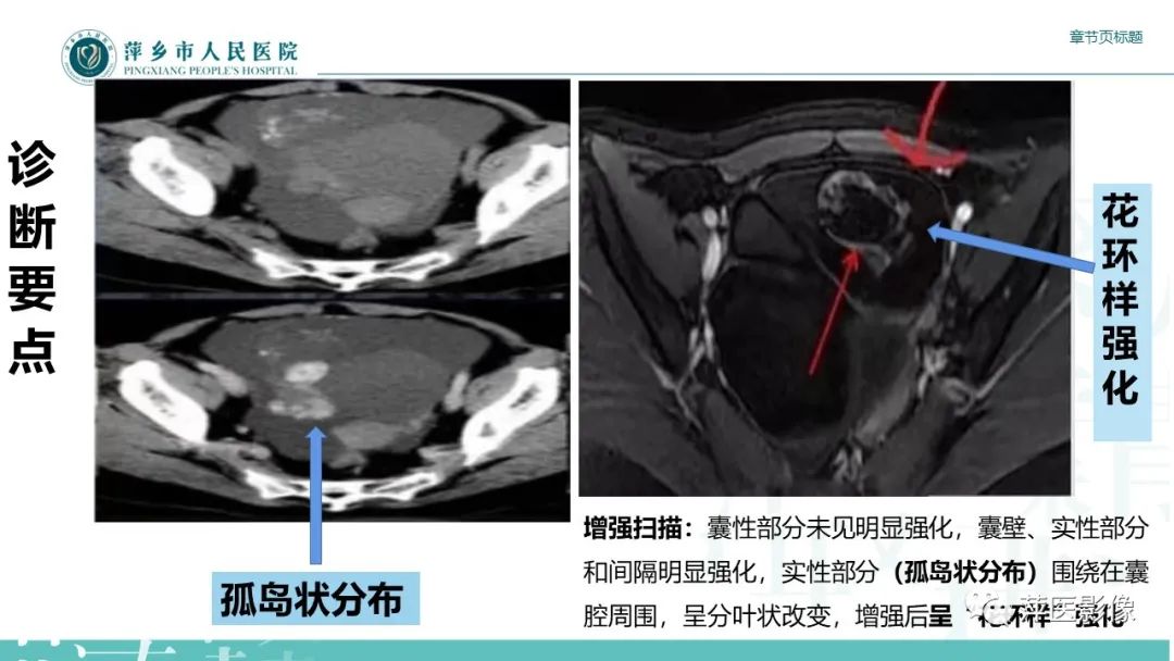 影像PPT - 【PPT】卵巢甲状腺肿-13