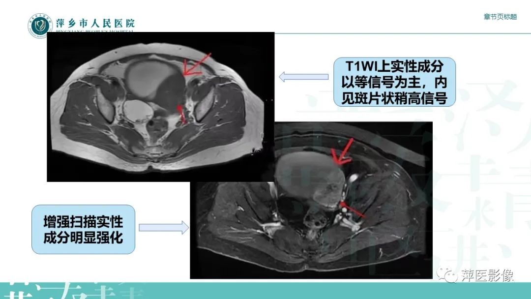 影像PPT - 【PPT】卵巢甲状腺肿-14