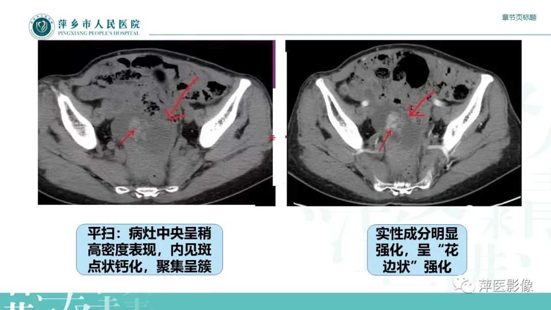 影像PPT - 【PPT】卵巢甲状腺肿-15