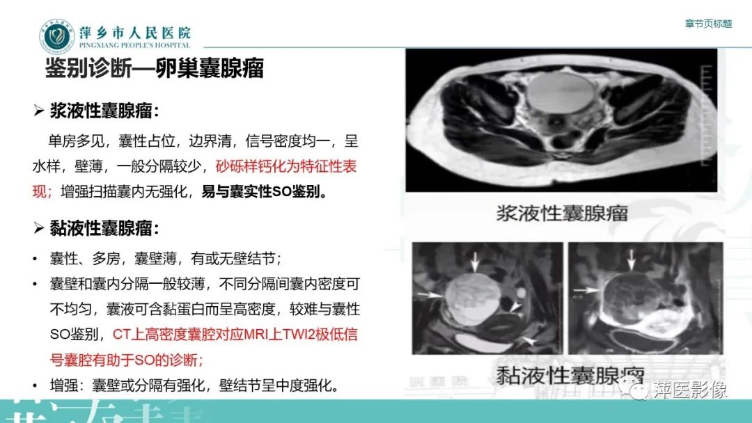 影像PPT - 【PPT】卵巢甲状腺肿-19