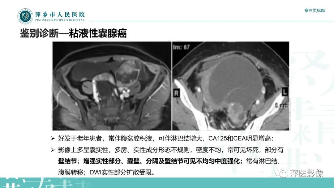 影像PPT - 【PPT】卵巢甲状腺肿-20