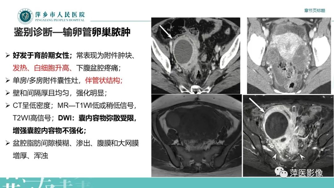 影像PPT - 【PPT】卵巢甲状腺肿-21