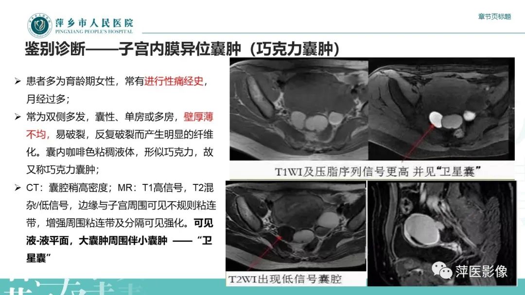 影像PPT - 【PPT】卵巢甲状腺肿-22