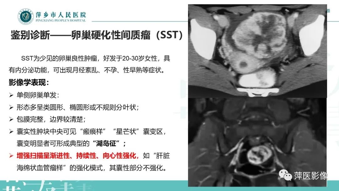 影像PPT - 【PPT】卵巢甲状腺肿-23