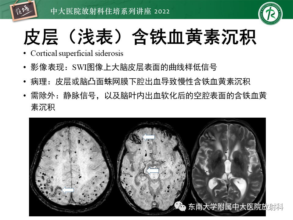 影像PPT - 【PPT】脑小血管病概念、影像维度及其深度学习进展-13