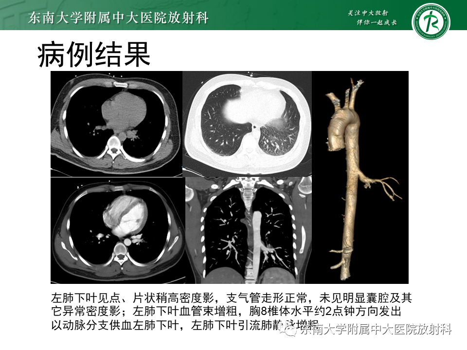 影像PPT - 【PPT】体循环供血左肺下叶-2