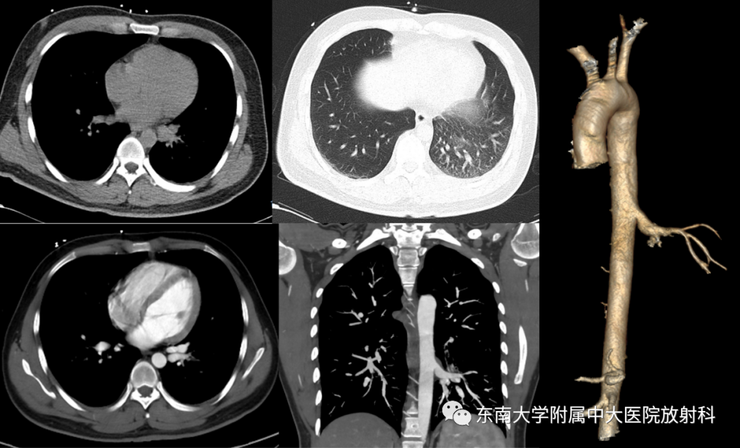 影像PPT - 【PPT】体循环供血左肺下叶-1