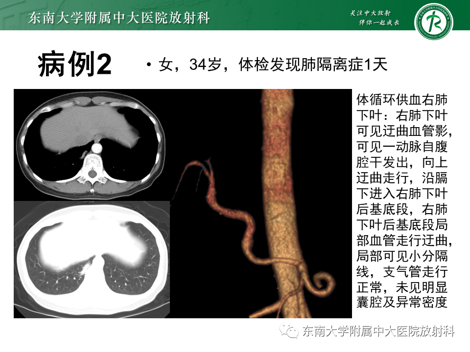 影像PPT - 【PPT】体循环供血左肺下叶-12