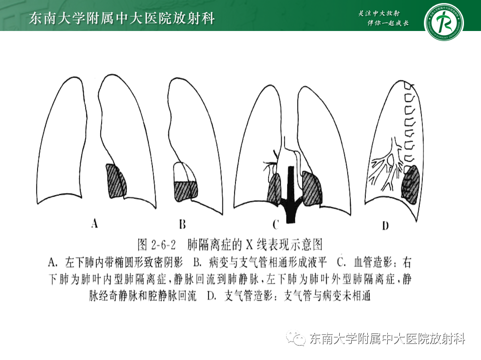 影像PPT - 【PPT】体循环供血左肺下叶-20