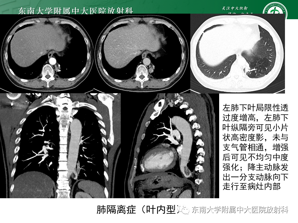 影像PPT - 【PPT】体循环供血左肺下叶-22