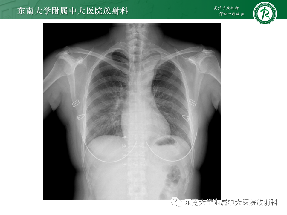 影像PPT - 【PPT】体循环供血左肺下叶-23