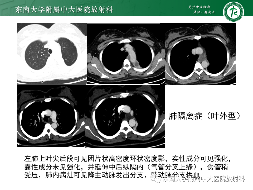 影像PPT - 【PPT】体循环供血左肺下叶-24