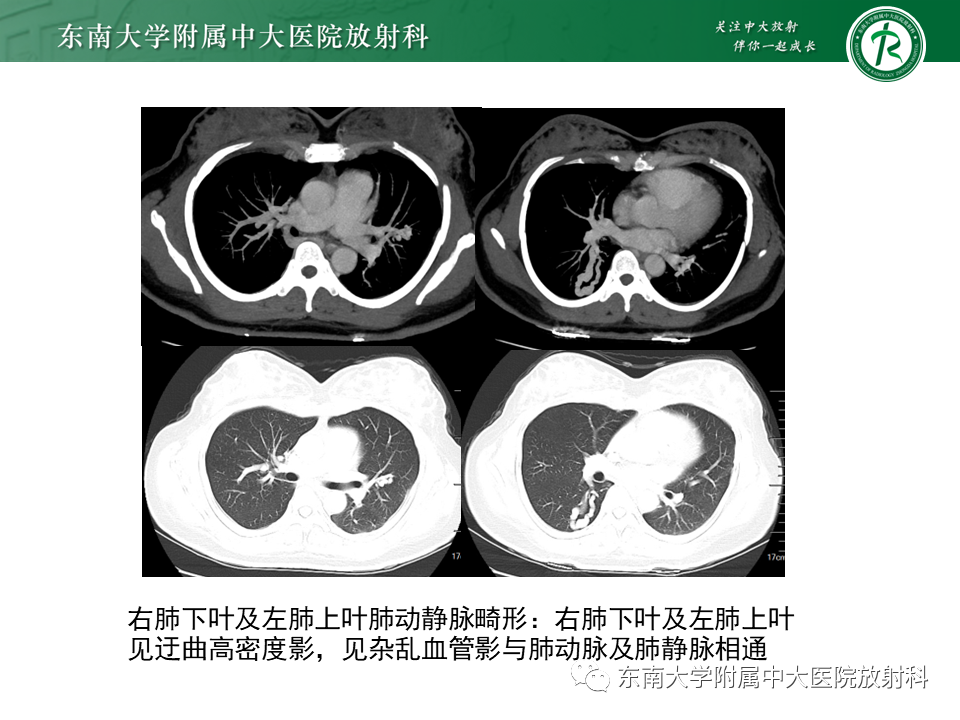 影像PPT - 【PPT】体循环供血左肺下叶-28