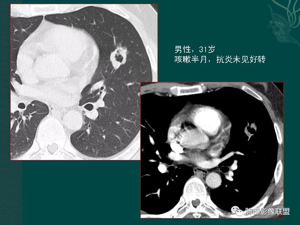 影像PPT - 【PPT】空洞型肺癌的影像诊断及鉴别-5