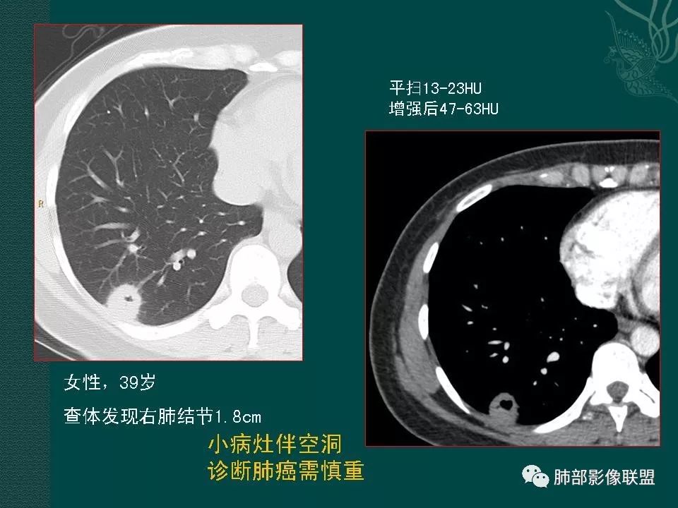影像PPT - 【PPT】空洞型肺癌的影像诊断及鉴别-8