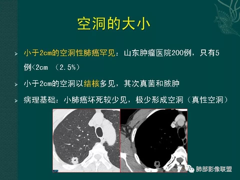 影像PPT - 【PPT】空洞型肺癌的影像诊断及鉴别-9