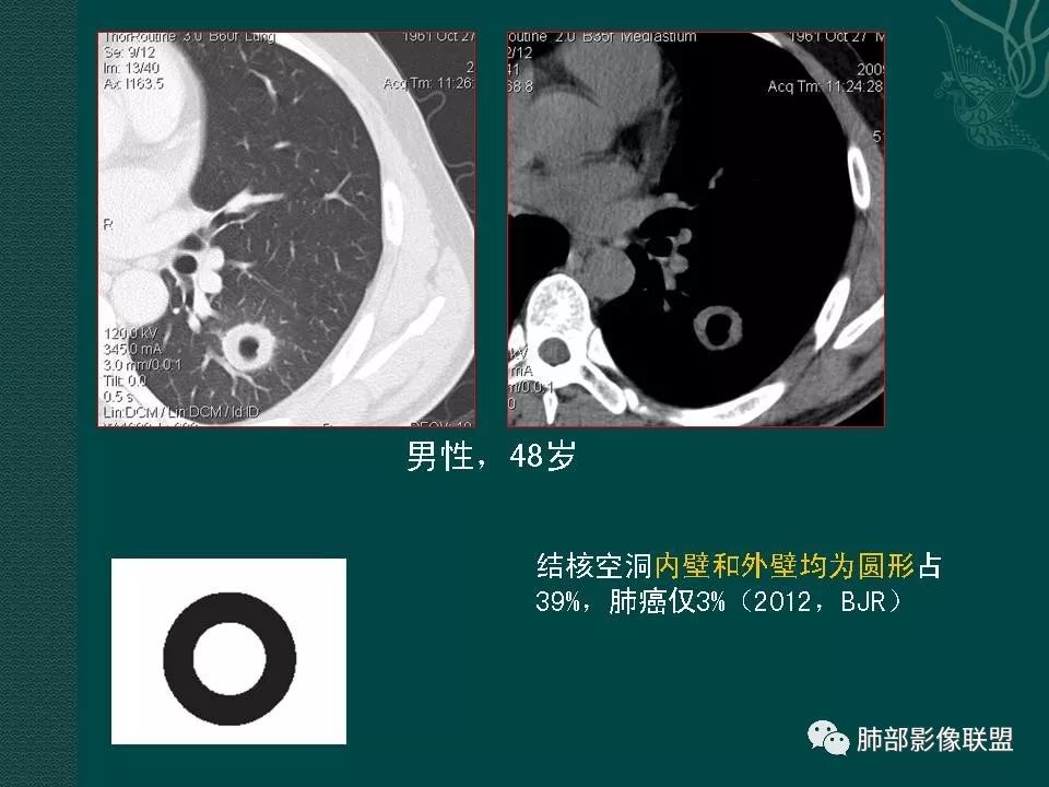 影像PPT - 【PPT】空洞型肺癌的影像诊断及鉴别-14