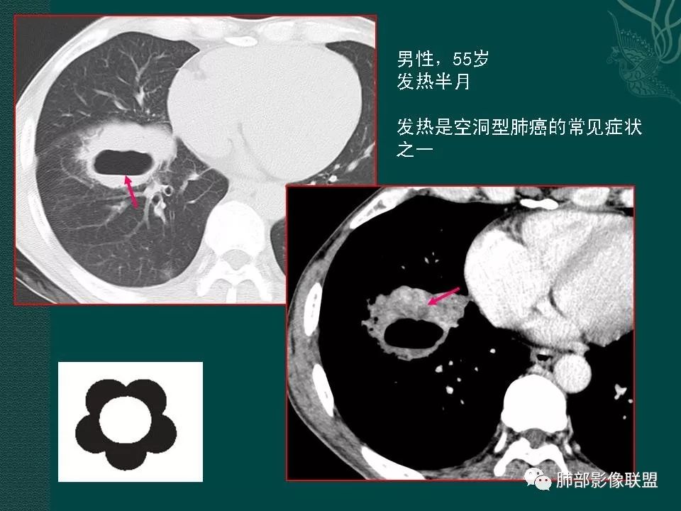 影像PPT - 【PPT】空洞型肺癌的影像诊断及鉴别-15
