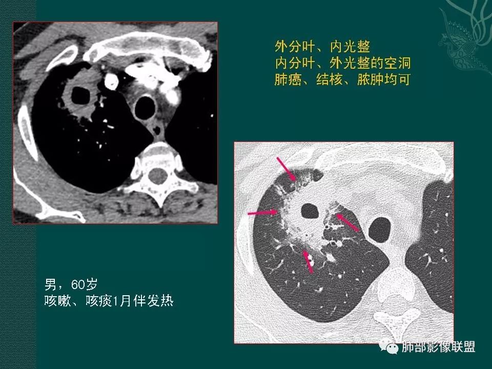 影像PPT - 【PPT】空洞型肺癌的影像诊断及鉴别-17