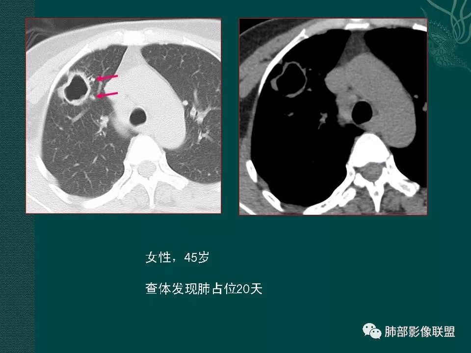 影像PPT - 【PPT】空洞型肺癌的影像诊断及鉴别-18
