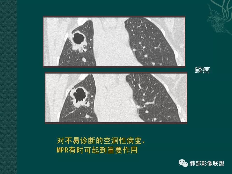 影像PPT - 【PPT】空洞型肺癌的影像诊断及鉴别-19