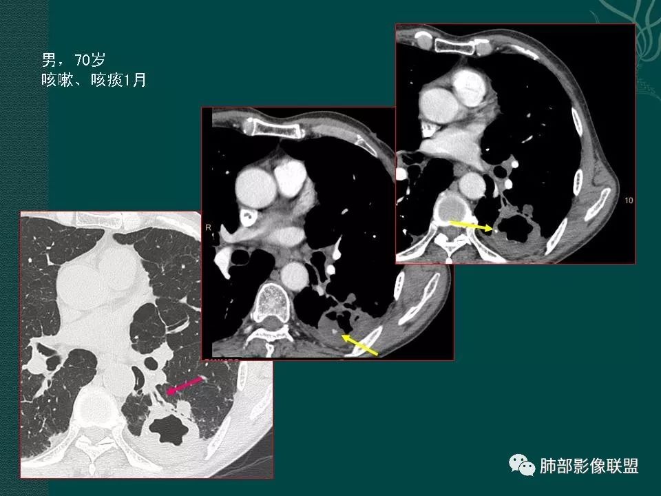 影像PPT - 【PPT】空洞型肺癌的影像诊断及鉴别-21