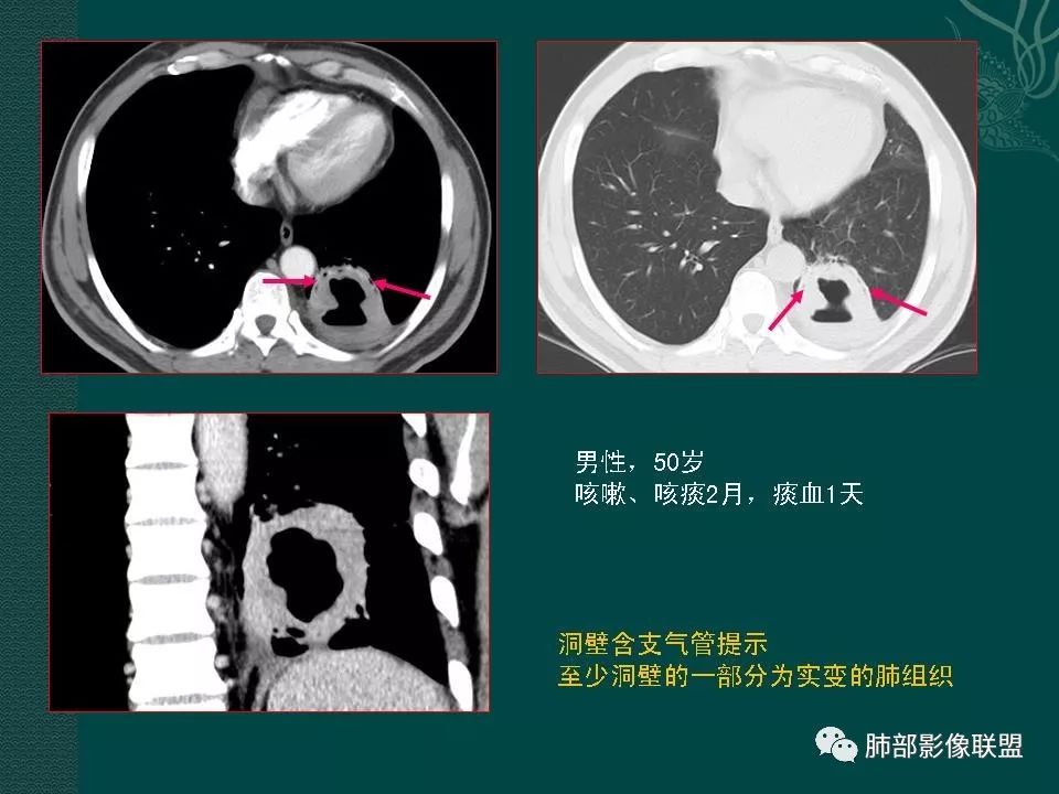 影像PPT - 【PPT】空洞型肺癌的影像诊断及鉴别-23